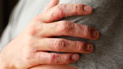 Psoriasis Fingers Stock Video Motion Array