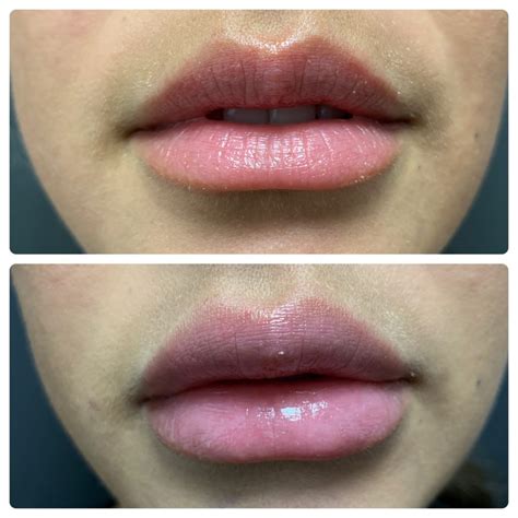 Lip Augmentation Surgery Risk Complications Cost Before And After