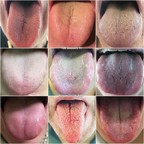 Tcm Monitoring Tongue Changes — Kenton Sefcik Rac Kenton Tcm