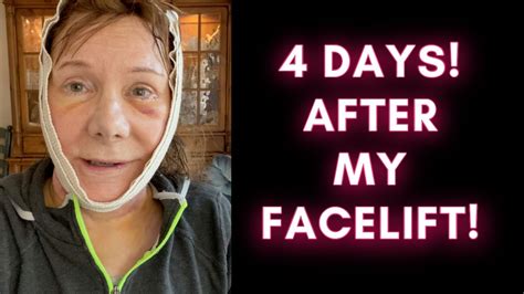 My Facelift Four Days Post Op Youtube