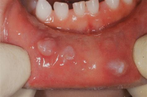 Multiple Mucoceles Of The Lower Lip A Case Report Abe 2019