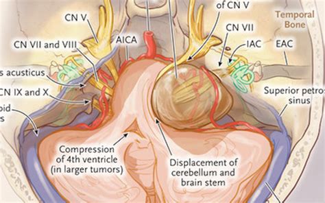 Vestibular Schwannoma Acoustic Neuroma