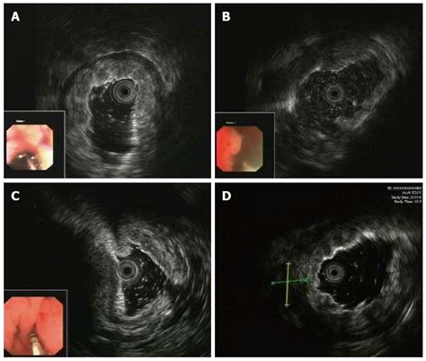 Endoscopic Ultrasound Guided Deep And Large Biopsy For Diagnosis Of
