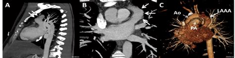 Contrast Enhanced Chest Ct In Sagittal A And Coronal Bmaximum