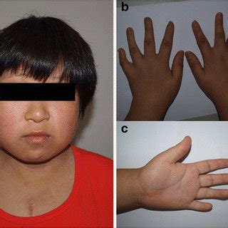 Epicanthal folds are normal in asians like in native americans and in korean population. (PDF) De Novo ring chromosome 11 and non-reciprocal ...