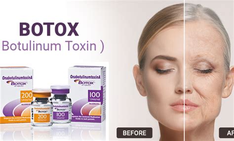 Allergan Botox Treatment Why You Should Go For It The Post City