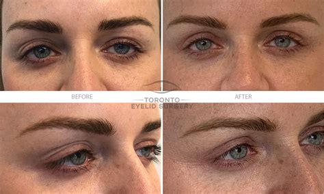 Before And After Toronto Eyelid Surgery
