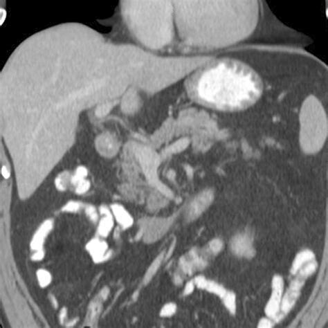 Normal Pancreas Coronal CT Of