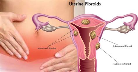 Underutilized Nonsurgical Treatment For Uterine Fibroids Parsemus