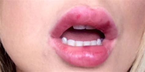 Hard Lump In Lip After Biting