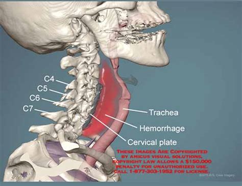 Amicus Illustration Of Amicus Animation C4 C5 C6 C7 Trachea Hemorrhage Cervical Plate