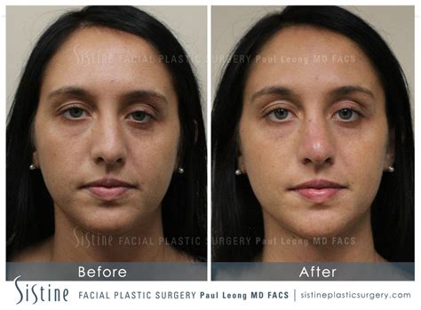 Plastic Surgery Before And After Nose Jobs
