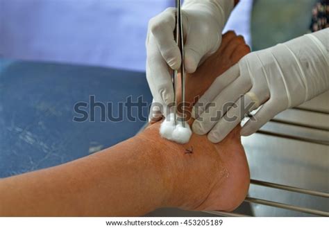 Doctor Dressing Sutured Wound Stock Photo 453205189 Shutterstock