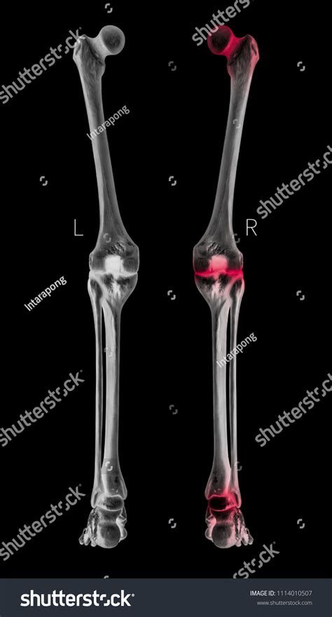 Xray Human Leg Bone Posterior View Stock Illustration 1114010507