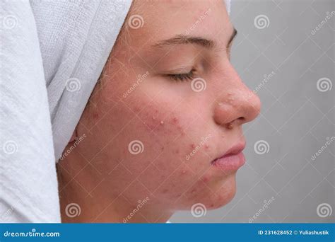 Acne Teenage Girl With The Pimples On Her Face Close Up Problematic
