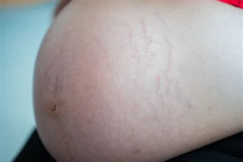 Pregnancy Belly Stretch Marks Skin Close Up Stock Image Everypixel