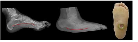 Charcot Ankle Charcot Foot Surgery — Foot Ankle Surgery