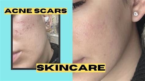 Bellafill And Clear And Brilliant Laser For Deep Acne Scars Improves My