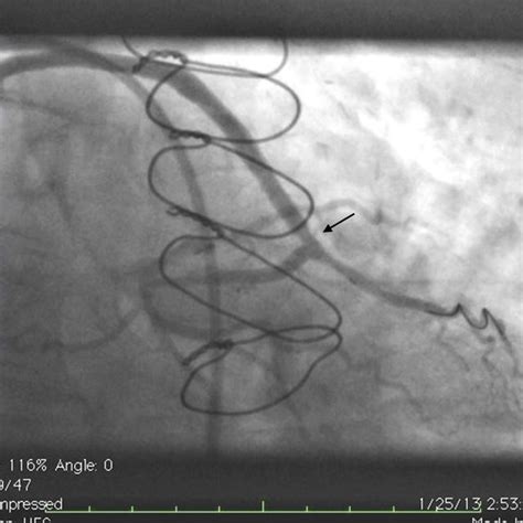 Angiogram Showing Expanded Stent After Cutting Balloon Angioplasty