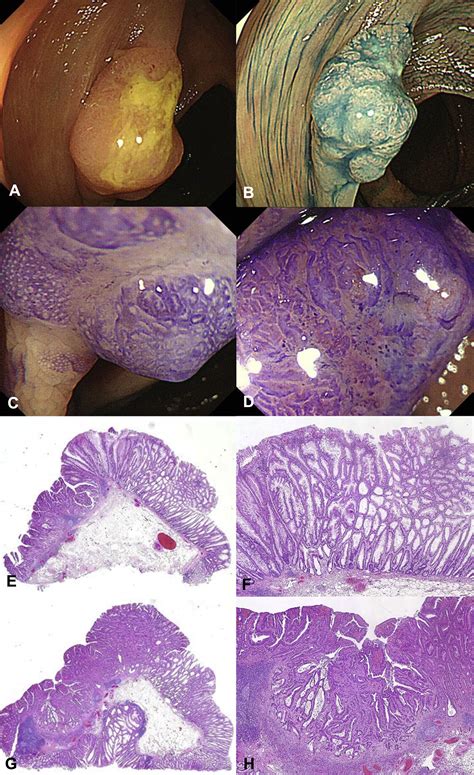Distinct Endoscopic Characteristics Of Sessile Serrated Adenoma Polyp