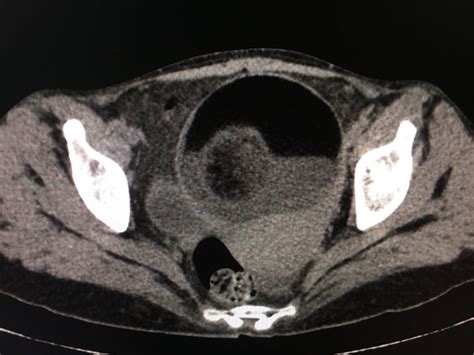Dermoid Cyst Pokeman Sign And Rokitansky Nodule Radiology Imaging