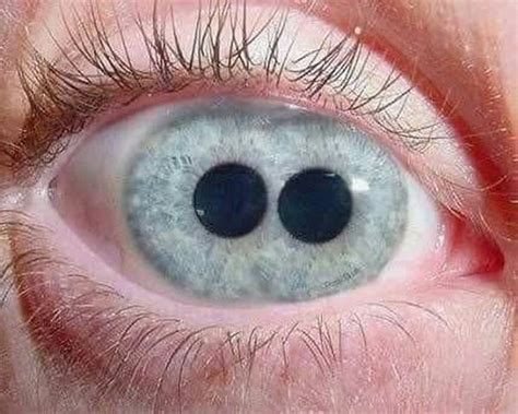 Two Pupils In One Eye