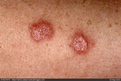 Stock Image Dermatology Erythema Multiforme Two Rounded And