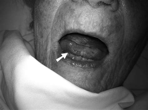 Necrotic Tongue A Rare Manifestation Of Giant Cell Arteritis The