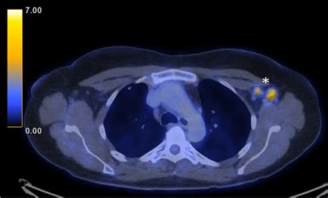 Fdg Petct Of The Lungs Demonstrating Highly Avid Left Axillary
