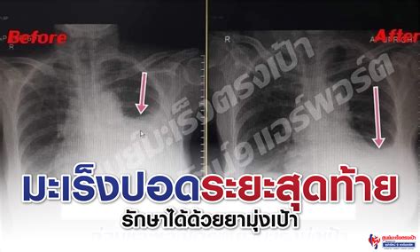 การรักษา มะเร็งปอดระยะสุดท้าย ศูนย์มะเร็งตรงเป้า โรงพยาบาลจุฬารัตน์