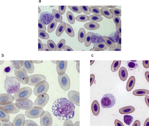 A Left Large Plasmacytoid Lymphocytes 6 To 10 μ M Illustrating The