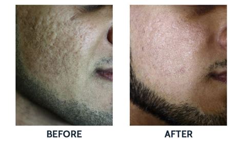 Co2re System Before After 3 Delray Dermatology Cosmetic Center
