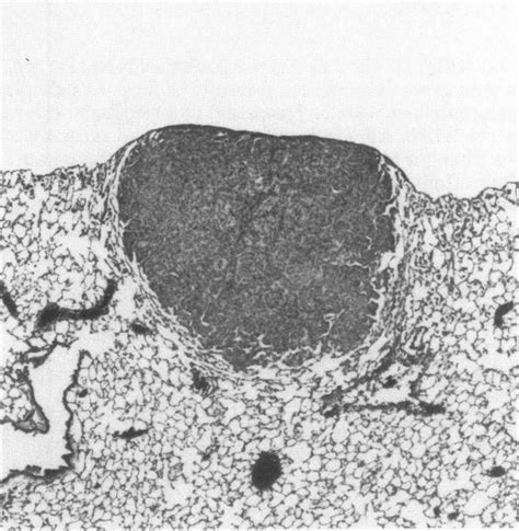 Alveolar Bronchiolar Adenoma This Photograph Shows A Low Magnification