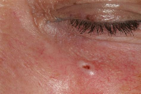 Skin Lesions Intechopen