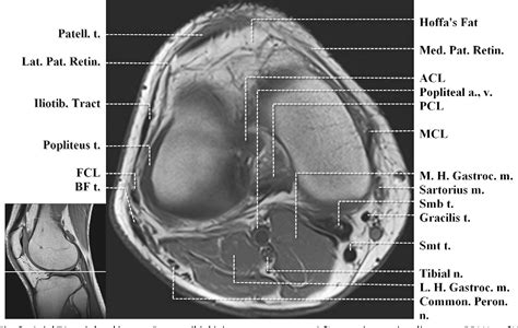 This section of the website will explain large and minute details of sagittal knee use the mouse scroll wheel to move the images up and down alternatively use the tiny arrows (>>) on both side of the image to move the images. Figure 3 from Normal MR imaging anatomy of the knee. | Semantic Scholar