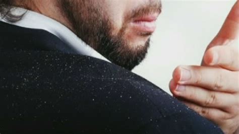 1 Of Every 5 People Suffer From Dandruff Men More So Than Others