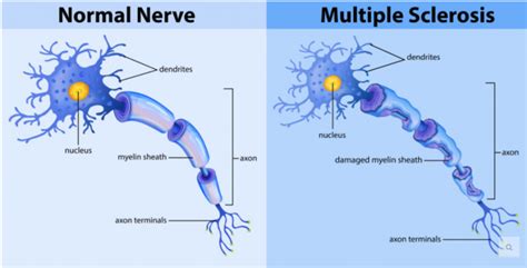Trabajando junto nuestras asociaciones en mejorar la calidad de vida de las personas con #esclerosismúltiple mientras buscamos una cura. Esclerosis múltiple. - centro activa || especialistas en ...