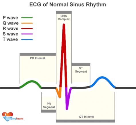 Ecg Rhythms Pr Interval Cardiac Nursing Normal Sinus Rhythm