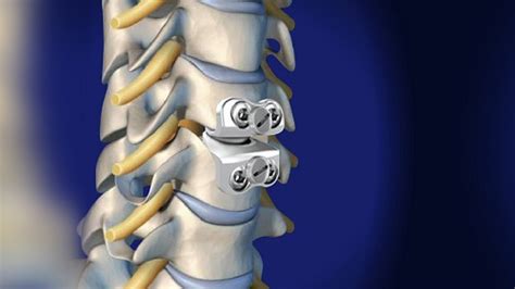 Spine Surgeon In Patna Lumber Disc Replacement Cervical Disc