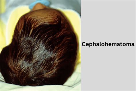 Understanding Cephalohematoma A Comprehensive Guide Dr Tapesh Clinic