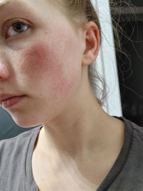 Skin Concerns Tiny Bumps On Cheeks That Never Go Away Skincareaddiction