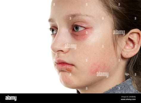 Allergic Reaction Skin Rash Close View Portrait Of A Girls Face