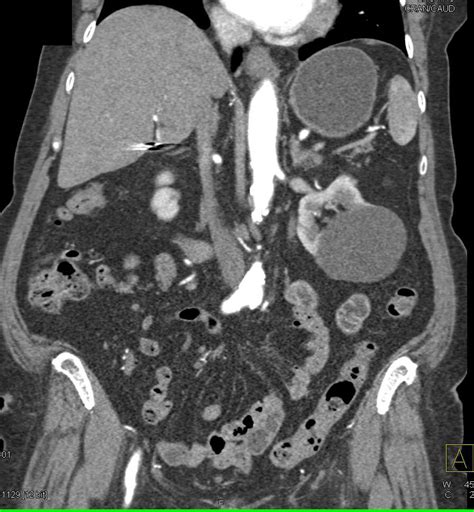 Carcinoid Tumor In Rlq With Liver Metastases Small Bowel Case Studies