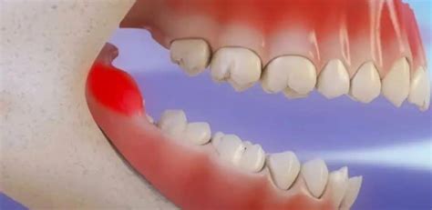 Sideways Wisdom Tooth Wisdom Teeth Removal Dentist In Ryde