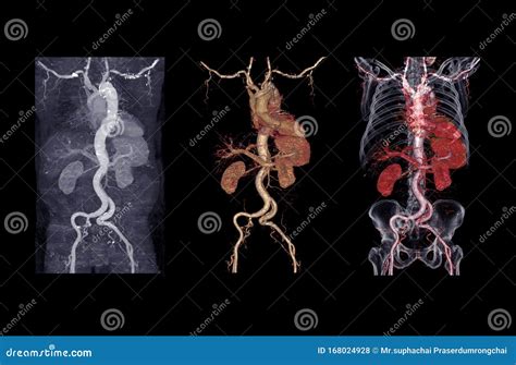 Cta Abdominal Aorta 3d Rendering Image Showing Aortic Dissection