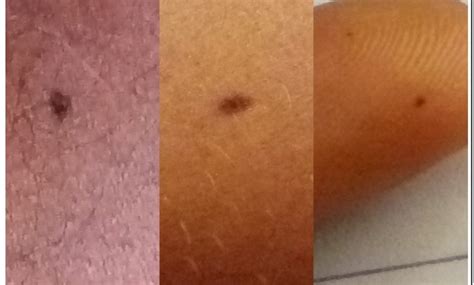 Tiny Black Dots On Skin Pictures Best Reviews