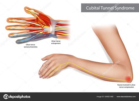 Ilustración Médica Para Explicar El Síndrome Del Túnel Cubital