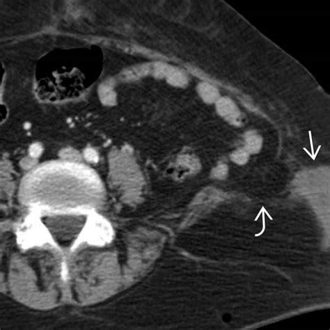 Traumatic Abdominal Wall Hernia Radiology Key
