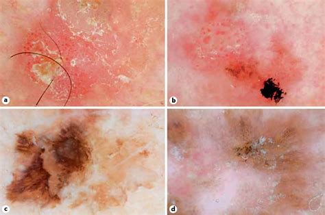 Dermoscopy Of Actinic Keratosis Intraepidermal Carcinoma And Squamous