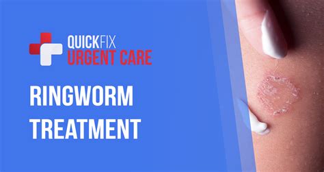Ringworm Treatment Quickfix Urgent Care